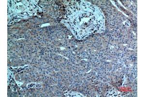 Immunohistochemistry (IHC) analysis of paraffin-embedded Human Breast Cancer, antibody was diluted at 1:100. (PLA2G4A 抗体  (N-Term))