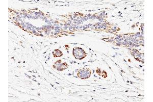 Formalin-fixed, paraffin-embedded human Breast Carcinoma stained with SM-MHC Mouse Monoclonal Antibody (MYH11/923). (MYH11 抗体)