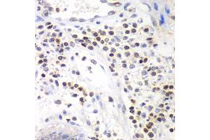 Immunohistochemistry of paraffin-embedded human colon using SMARCA4 antibody (ABIN6290438) at dilution of 1:100 (40x lens). (SMARCA4 抗体)