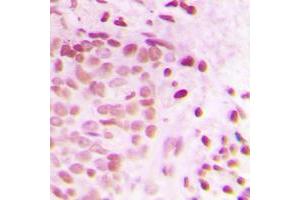 Immunohistochemical analysis of ATRIP staining in human breast cancer formalin fixed paraffin embedded tissue section. (ATRIP 抗体  (N-Term))