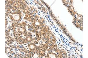The image on the left is immunohistochemistry of paraffin-embedded Human thyroid cancer tissue using ABIN7192279(SCN2A Antibody) at dilution 1/25, on the right is treated with synthetic peptide. (SCN2A 抗体)