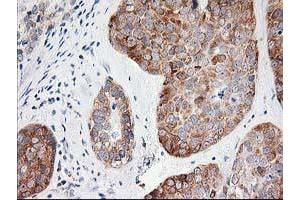 Immunohistochemical staining of paraffin-embedded Adenocarcinoma of Human breast tissue using anti-LCMT1 mouse monoclonal antibody. (LCMT1 抗体)