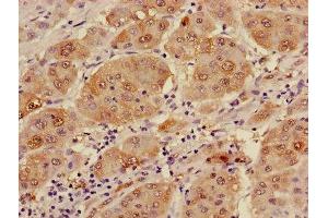 Immunohistochemistry of paraffin-embedded human liver cancer using ABIN7143645 at dilution of 1:100 (ADH1B 抗体  (AA 2-375))