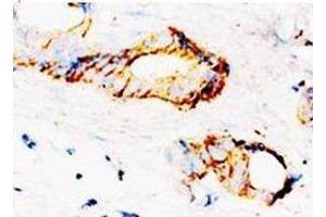 Immunohistochemical analysis of paraffin-embedded mammary cancer sections, staining SAMDC in cytoplasm, DAB Chromogenic reaction (AMD1 抗体  (C-Term))
