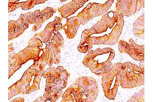 Formalin-fixed, paraffin-embedded human Colon Carcinoma stained with Multi Cytokeratin Mouse Monoclonal Antibody (C11). (KRT4, KRT5, KRT6, KRT8, KRT10, KRT13, KRT18 抗体)