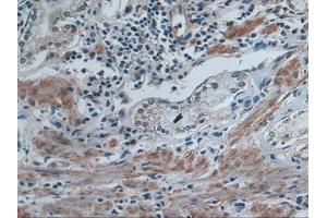 IHC-P analysis of Human Stomach Cancer Tissue, with DAB staining. (IDE 抗体  (AA 753-973))
