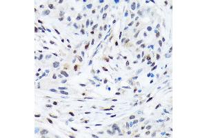Immunohistochemistry of paraffin-embedded human esophageal cancer using TFE3 Rabbit mAb (ABIN1683323, ABIN3015205, ABIN3015206 and ABIN7101320) at dilution of 1:100 (40x lens). (TFE3 抗体)
