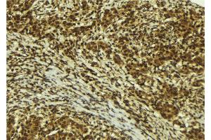ABIN6272493 at 1/100 staining Human breast cancer tissue by IHC-P. (ZNF295 抗体  (N-Term))