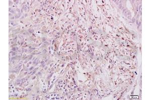 Formalin-fixed and paraffin embedded human gastric carcinoma labeled with Anti-Dnmt3a Polyclonal Antibody, Unconjugated (ABIN669336) at 1:200, followed by conjugation to the secondary antibody and DAB staining (DNMT3A 抗体  (AA 26-100))