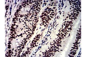 Immunohistochemical analysis of paraffin-embedded rectum cancer tissues using NAGR1 mouse mAb with DAB staining.