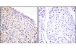Immunohistochemistry analysis of paraffin-embedded human breast carcinoma, using SYK (Phospho-Tyr525) Antibody.