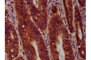IHC image of ABIN7168647 diluted at 1:400 and staining in paraffin-embedded human colon cancer performed on a Leica BondTM system. (SEC14L2 抗体  (AA 233-358))
