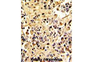 Formalin-fixed and paraffin-embedded human kidney carcinoma with Neprilysin Antibody (C-term), which was peroxidase-conjugated to the secondary antibody, followed by DAB staining. (MME 抗体  (C-Term))