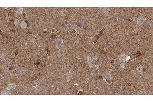 ABIN6277785 at 1/100 staining Human brain cancer tissue by IHC-P. (Doublecortin 抗体  (pSer335))