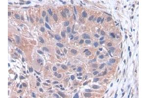 DAB staining on IHC-P; Samples: Human Lung cancer Tissue (pPLA2 抗体  (AA 16-148))