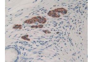 IHC-P analysis of Human Pancreas Cancer Tissue, with DAB staining. (CHGB 抗体  (AA 496-669))