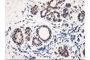 Immunohistochemical staining of paraffin-embedded Human breast tissue using anti-TP53I3 mouse monoclonal antibody. (TP53I3 抗体)
