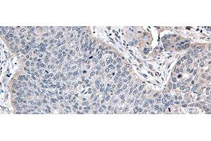 Immunohistochemistry of paraffin-embedded Human lung cancer tissue using ZFAND5 Polyclonal Antibody at dilution of 1:35(x200) (ZFAND5 抗体)