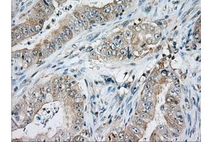Immunohistochemical staining of paraffin-embedded Adenocarcinoma of Human ovary tissue using anti-CD5 mouse monoclonal antibody. (CD5 抗体)