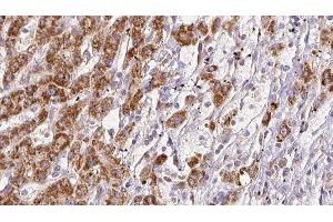 ABIN6278126 at 1/100 staining Human liver cancer tissue by IHC-P. (SEMA4D/CD100 抗体  (C-Term))