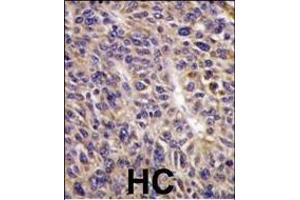 Formalin-fixed and paraffin-embedded human hepatocarcinoma reacted with UBE2L6 Antibody (N-term) (ABIN1882146 and ABIN2839155) , which was peroxidase-conjugated to the secondary antibody, followed by DAB staining. (UBE2L6 抗体  (N-Term))