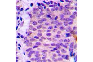 Immunohistochemical analysis of ATG4C staining in human prostate cancer formalin fixed paraffin embedded tissue section. (ATG4C 抗体  (N-Term))
