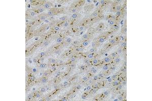 Immunohistochemistry of paraffin-embedded human liver injury using MAPK1 antibody (ABIN5998180) at dilution of 1/100 (40x lens). (ERK2 抗体)