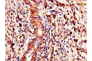 Immunohistochemistry of paraffin-embedded human gastric cancer using ABIN7148300 at dilution of 1:100 (COMMD1 抗体  (AA 2-190))
