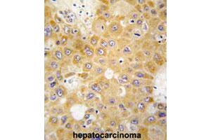 Formalin-fixed and paraffin-embedded human hepatocarcinomareacted with APH1A polyclonal antibody , which was peroxidase-conjugated to the secondary antibody, followed by AEC staining. (APH1A 抗体  (N-Term))