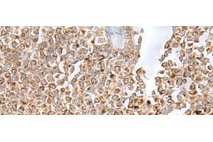 Immunohistochemistry of paraffin-embedded Human ovarian cancer tissue using GLYAT Polyclonal Antibody at dilution of 1:50(x200) (GLYAT 抗体)