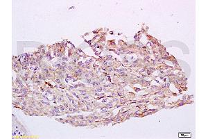 Formalin-fixed and paraffin embedded human cervical carcinoma tissue labeled with Anti-CYP24A1 Polyclonal Antibody, Unconjugated (ABIN750838) at 1:200 followed by conjugation to the secondary antibody and DAB staining