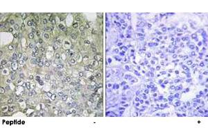 Immunohistochemistry analysis of paraffin-embedded human breast carcinoma tissue using ADRA1D polyclonal antibody . (ADRA1D 抗体)