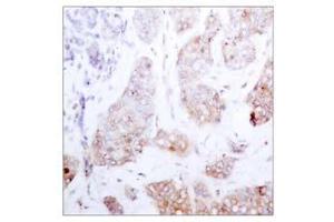 Immunohistochemical analysis of paraffin-embedded human breast carcinoma tissue using Raf-1 (Ab-259) antibody (E021006). (RAF1 抗体)