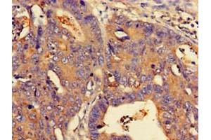 Immunohistochemistry of paraffin-embedded human colon cancer using ABIN7160778 at dilution of 1:100 (NMI 抗体  (AA 62-202))