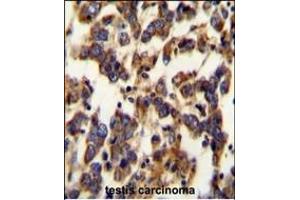 BSCL2 Antibody (N-term) (ABIN654071 and ABIN2843967) immunohistochemistry analysis in formalin fixed and paraffin embedded human testis carcinoma followed by peroxidase conjugation of the secondary antibody and DAB staining. (BSCL2 抗体  (N-Term))