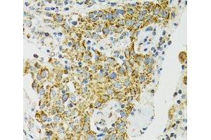 Immunohistochemistry of paraffin-embedded Human lung cancer using HSPA9 Polyclonal Antibody at dilution of 1:100 (40x lens). (HSPA9 抗体)