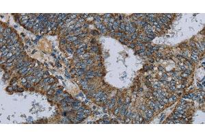Immunohistochemistry of paraffin-embedded Human colon cancer using NDUFA5 Polyclonal Antibody at dilution of 1:60 (NDUFA5 抗体)