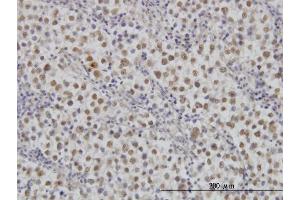 Immunoperoxidase of monoclonal antibody to MAP2K3 on formalin-fixed paraffin-embedded human dysgerminoma. (MAP2K3 抗体  (AA 1-100))