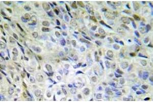 Immunohistochemistry (IHC) analyzes of p-beta-catenin (pSer33/pSer37/pThr41) antibody in paraffin-embedded human lung adenocarcinoma tissue. (CTNNB1 抗体  (pSer33, pSer37, pThr41))