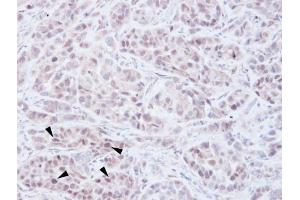IHC-P Image Immunohistochemical analysis of paraffin-embedded A549 xenograft, using NSD2, antibody at 1:100 dilution. (WHSC1 抗体  (N-Term))