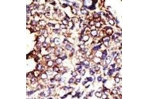 Formalin-fixed and paraffin-embedded human cancer tissue reacted with the primary antibody, which was peroxidase-conjugated to the secondary antibody, followed by DAB staining. (GCNT1 抗体  (AA 88-117))