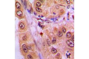 Immunohistochemistry (IHC) image for anti-Signal Transducer and Activator of Transcription 3 (Acute-Phase Response Factor) (STAT3) (C-Term), (pTyr705) antibody (ABIN7299462)