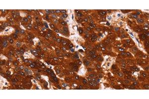 Immunohistochemistry of paraffin-embedded Human liver cancer using GPR124 Polyclonal Antibody at dilution of 1:40 (GPR124 抗体)
