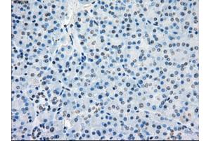 Immunohistochemical staining of paraffin-embedded Adenocarcinoma of colon tissue using anti-BUB1Bmouse monoclonal antibody. (BUB1B 抗体)