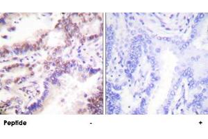 Immunohistochemistry analysis of paraffin-embedded human lung carcinoma tissue using RBBP8 polyclonal antibody . (Retinoblastoma Binding Protein 8 抗体)