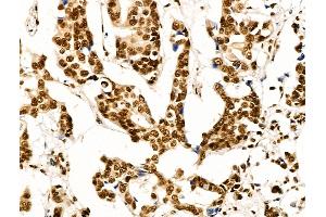 ABIN7094736 and ABIN7098787 at 1/100 staining Human breast cancer by IHC-P.