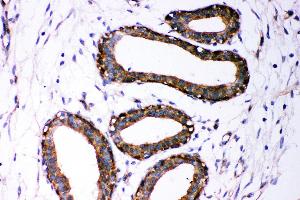 Anti- Dicer antibody, IHC(P) IHC(P): Human Mammary Cancer Tissue (DICER1 抗体  (AA 1-195))