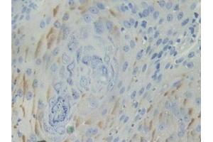 IHC-P analysis of Human Skin cancer Tissue, with DAB staining. (BCAM 抗体  (AA 32-257))