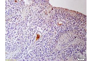 Formalin-fixed and paraffin embedded human glioma tissue labeled with Anti IGFR3/CD16 Polyclonal Antibody, Unconjugated (ABIN761381) at 1:200 followed by conjugation to the secondary antibody and DAB staining (CD16a, CD16b (AA 131-230) 抗体)