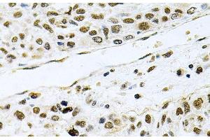 Immunohistochemistry of paraffin-embedded Human lung cancer using MCL1 Polyclonal Antibody at dilution of 1:100 (40x lens). (MCL-1 抗体)